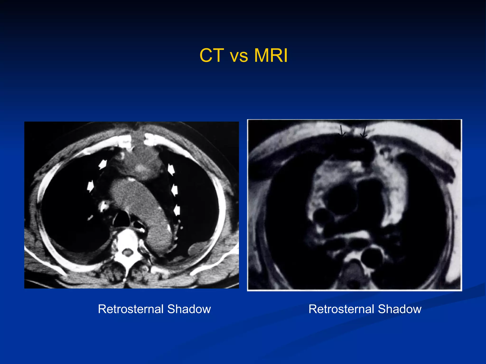 CT vs MRI Retrosternal Shadow Retrosternal Shadow 