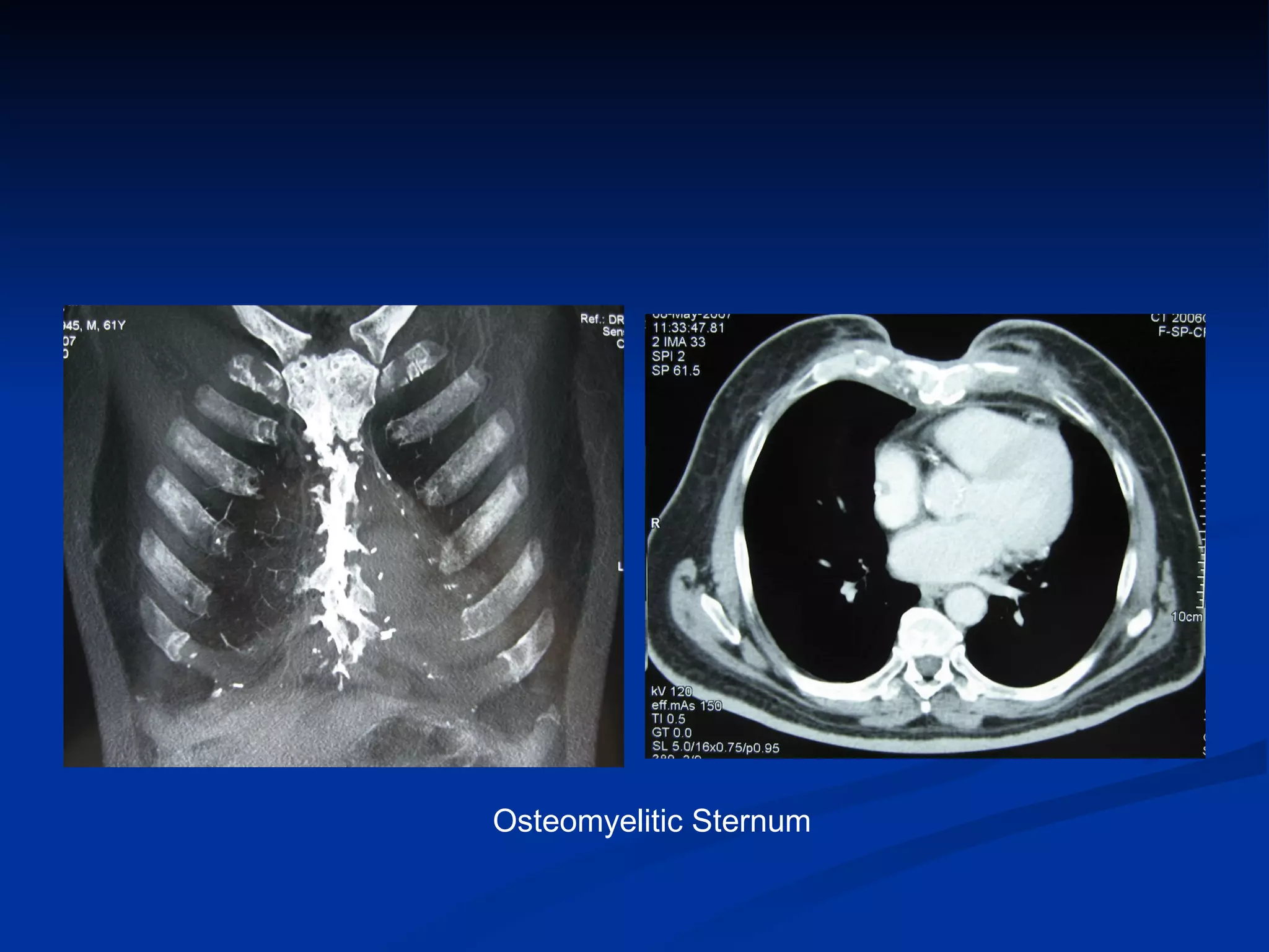 Osteomyelitic Sternum 