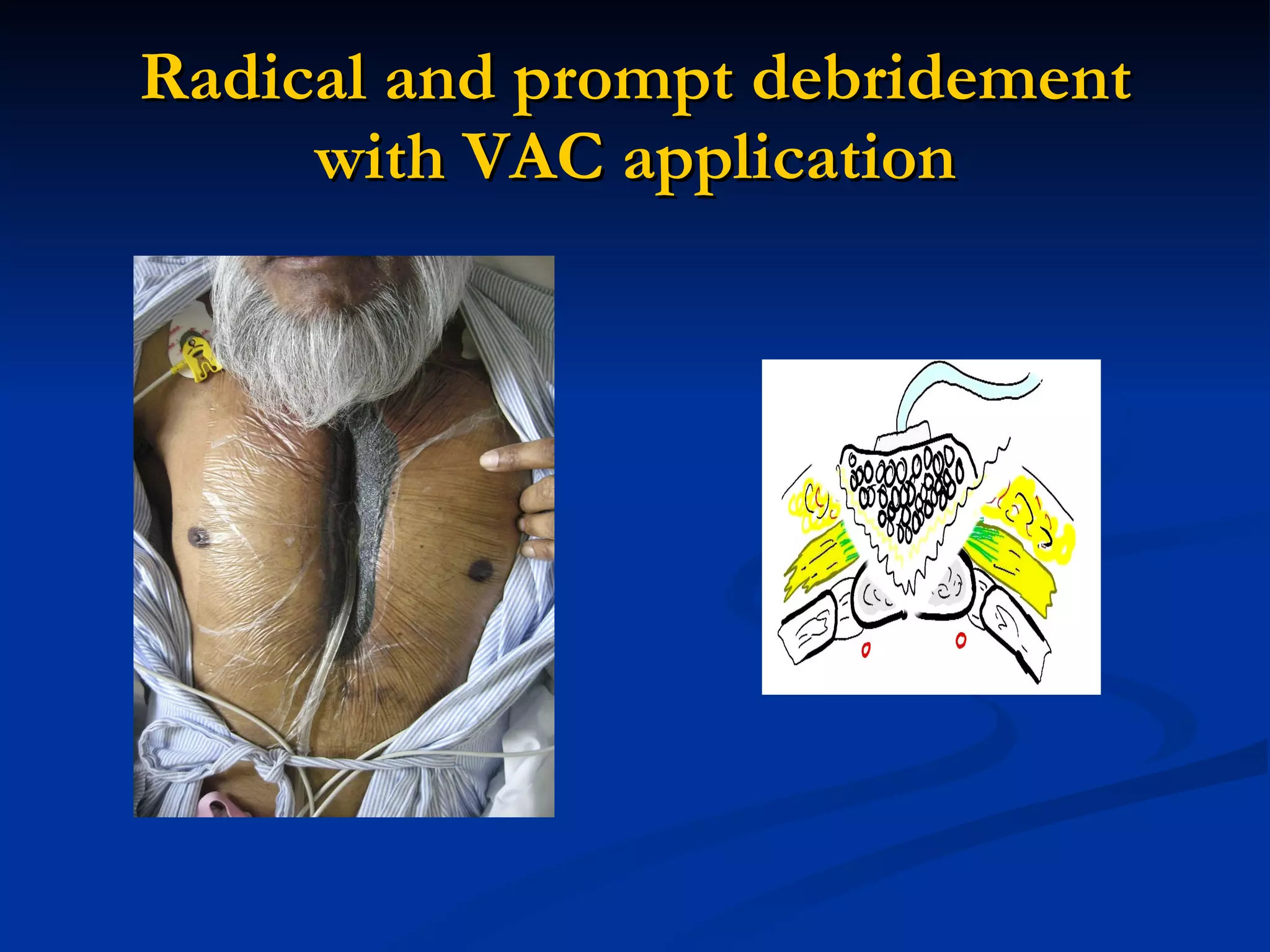 Radical and prompt debridement with VAC application 