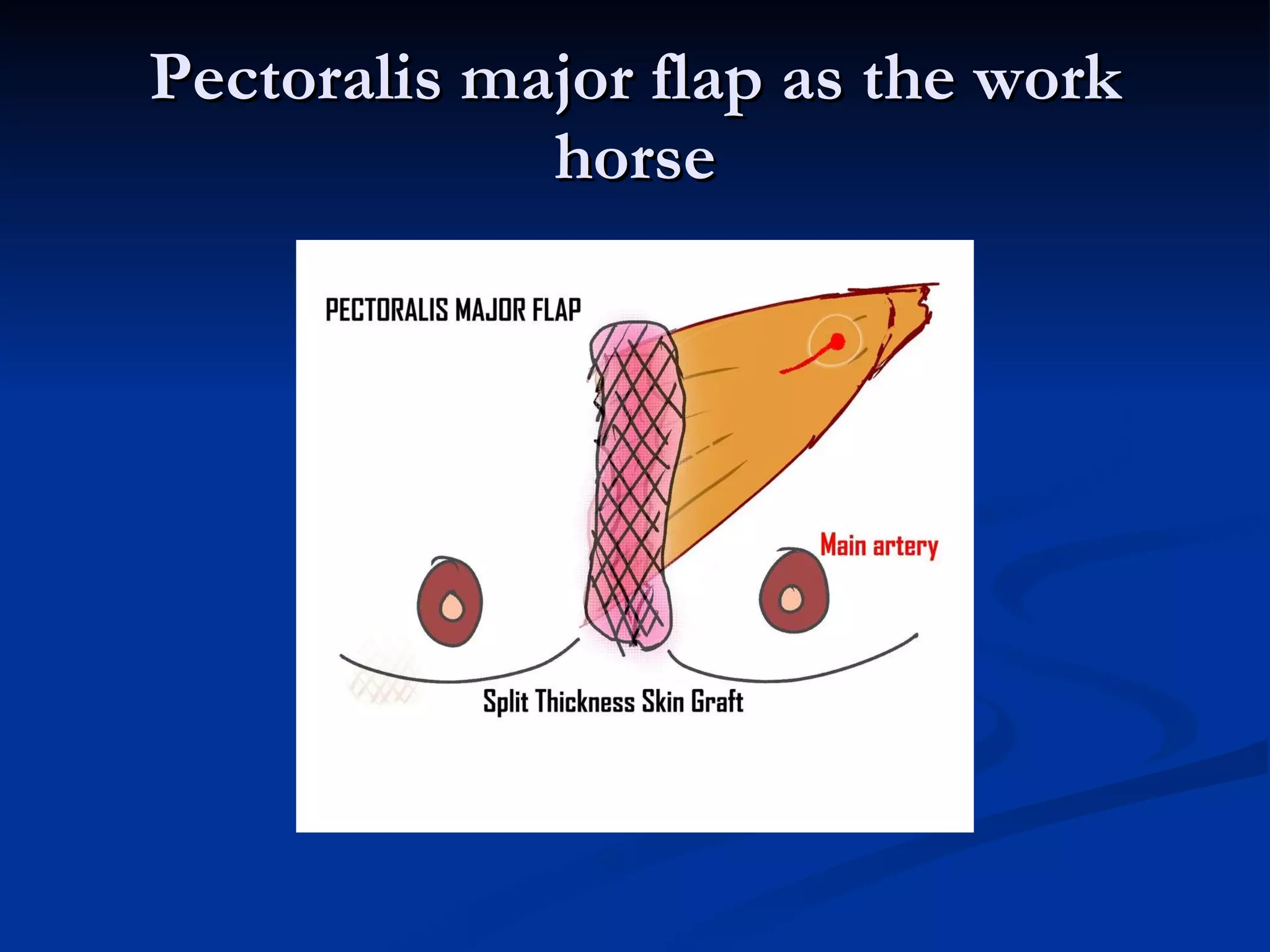 Pectoralis major flap as the work horse 