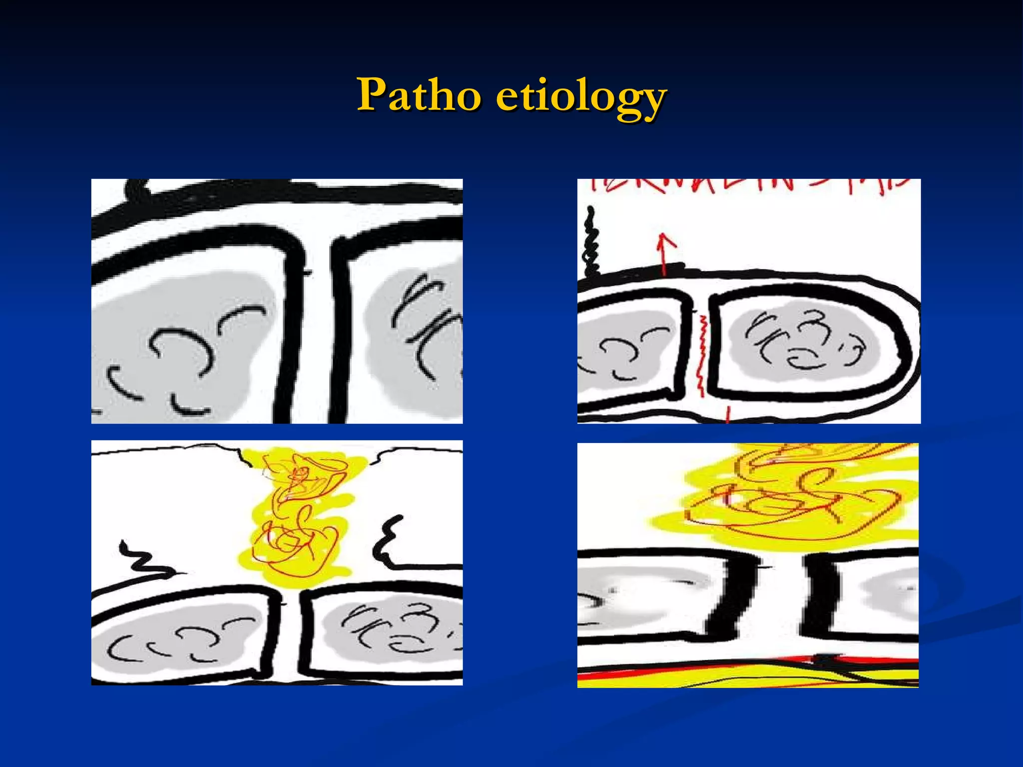 Patho etiology 