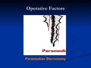 Operative Factors Paramedian Sternotomy 