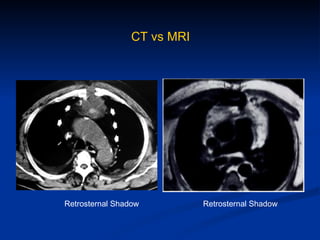 CT vs MRI Retrosternal Shadow Retrosternal Shadow 