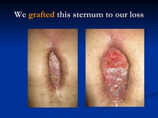We  grafted  this sternum to our loss 
