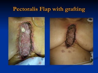 Pectoralis Flap with grafting 