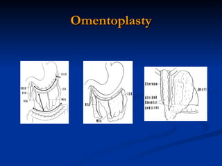 Omentoplasty 