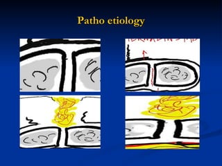 Patho etiology 
