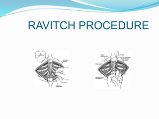 Ravitch Incision Sternal/ Chest wall deformities and Tumors | PPTX