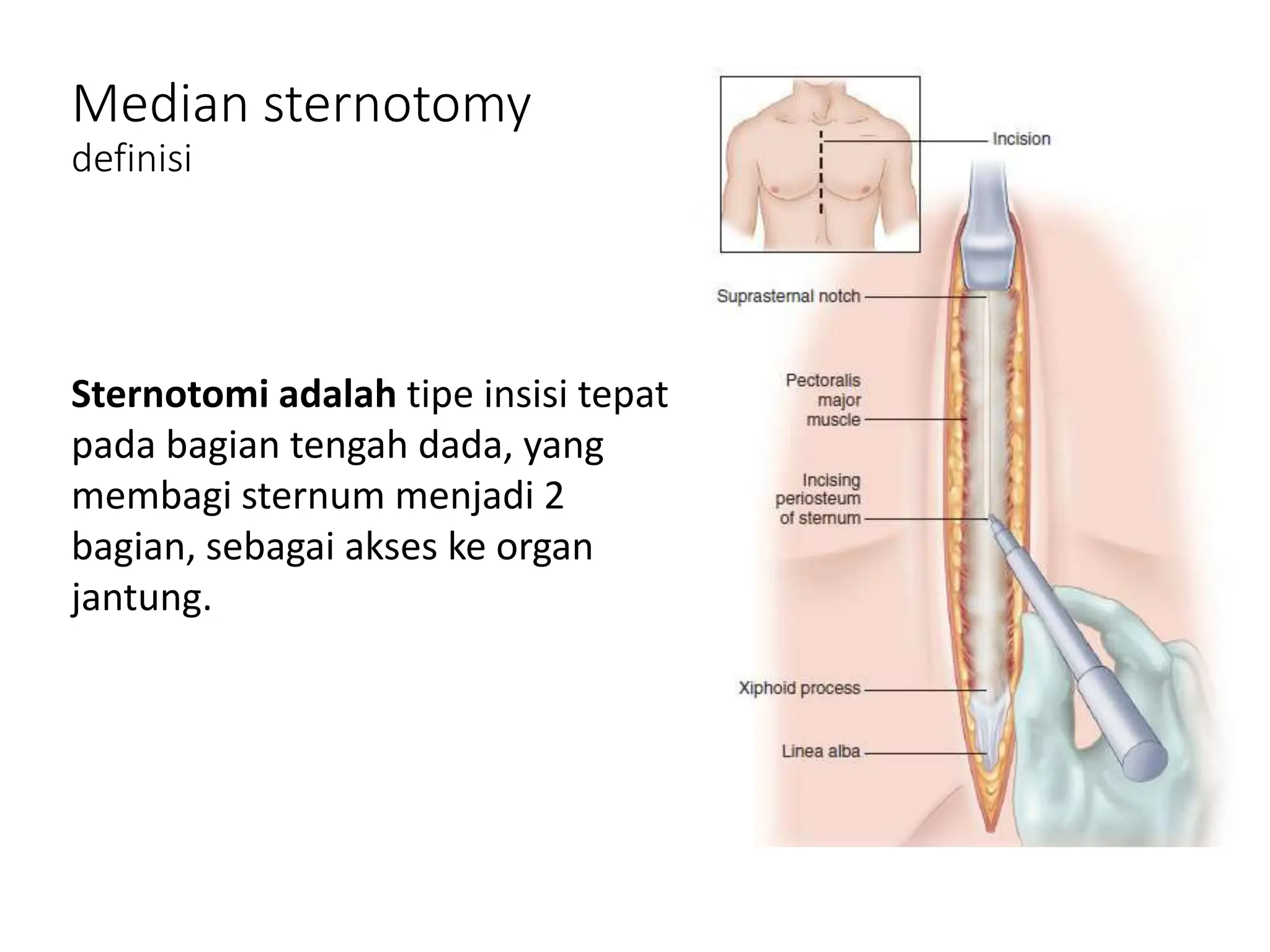 Sternotomi on p3diatric Heart surgery II | PPTX