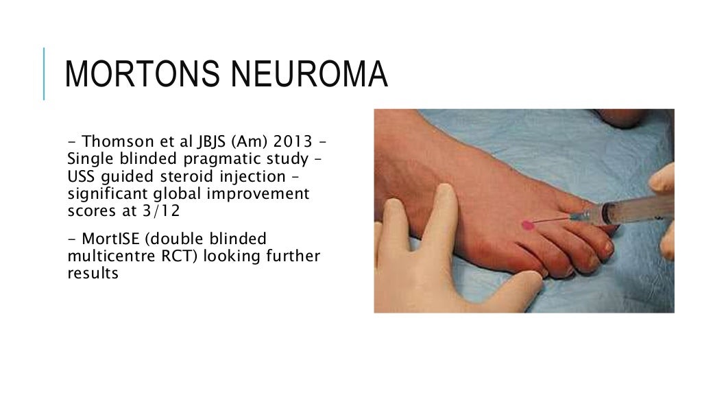 Steroid injections in the foot & ankle