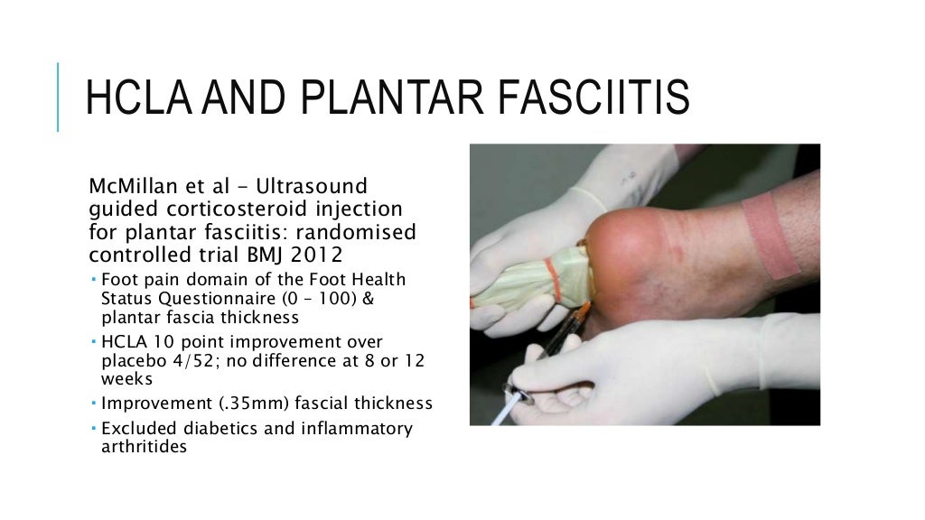 Steroid injections in the foot & ankle