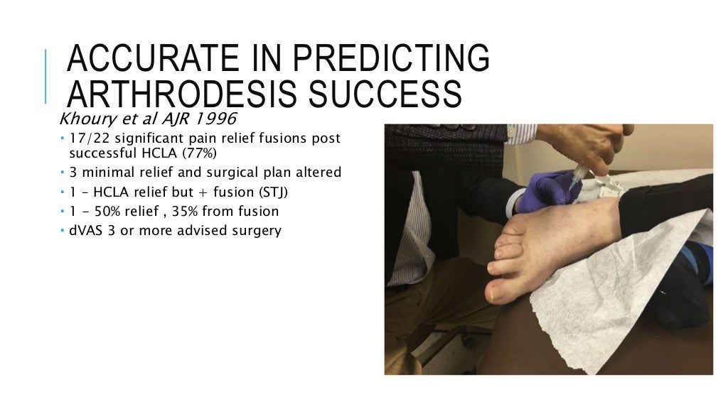 Steroid injections in the foot & ankle