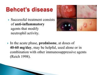  In the acute phase, prednisone, at doses of
40-60 mg/day, may be helpful, used alone or in
combination with other immunosuppressive agents
(Reich 1998).
 Successful treatment consists
of anti-inflammatory
agents that modify
neutrophil activity.
 