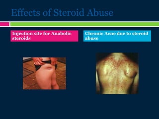 Effects of Steroid Abuse
Injection site for Anabolic
steroids
Chronic Acne due to steroid
abuse
 