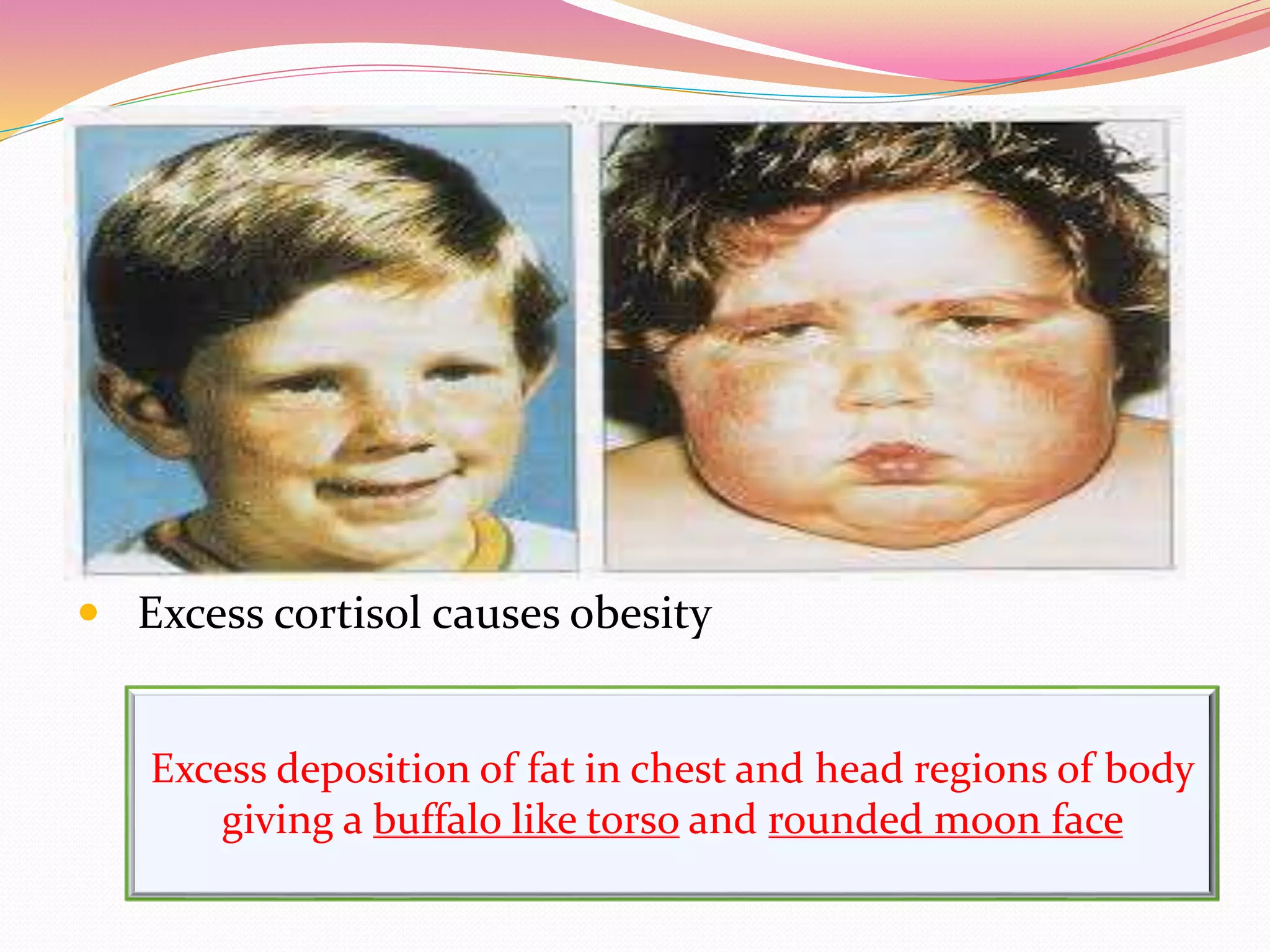 3.Effect on fat metabolism
 Mobilization of fatty acids
 Excess cortisol causes obesity
It promotes mobilization of free fatty acids from adipose
tissue
Increases the concentration of free fatty acids in plasma ,
which increases there utilization for energy
Excess deposition of fat in chest and head regions of body
giving a buffalo like torso and rounded moon face
 