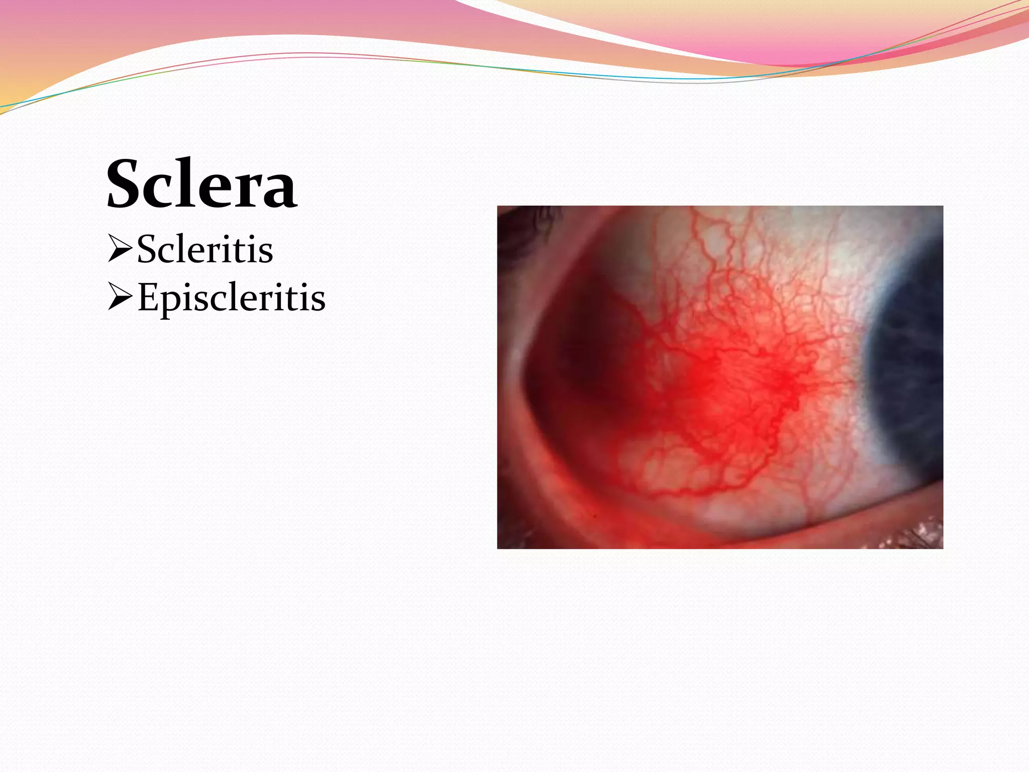 Sclera
Scleritis
Episcleritis
 