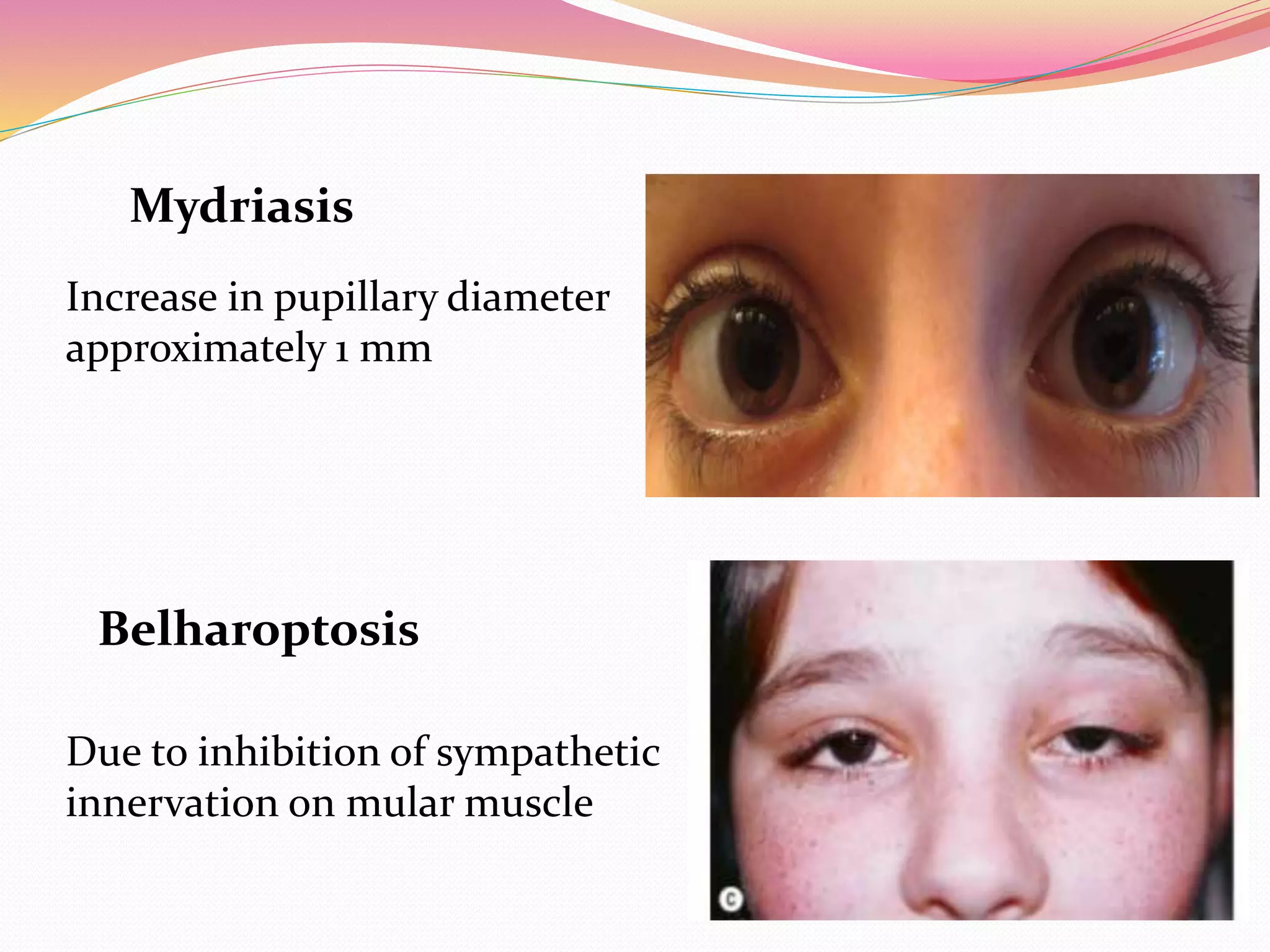 Mydriasis
Increase in pupillary diameter
approximately 1 mm
Belharoptosis
Due to inhibition of sympathetic
innervation on mular muscle
 