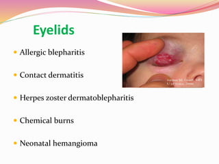 Eyelids
 Allergic blepharitis
 Contact dermatitis
 Herpes zoster dermatoblepharitis
 Chemical burns
 Neonatal hemangioma
 