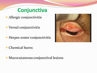 Conjunctiva
 Allergic conjunctivitis
 Vernal conjunctivitis
 Herpes zoster conjunctivitis
 Chemical burns
 Mucocutaneous conjunctival lesions
 