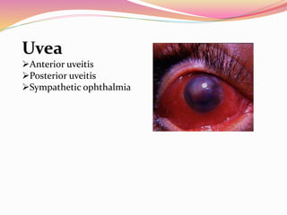Uvea
Anterior uveitis
Posterior uveitis
Sympathetic ophthalmia
 