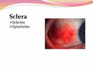 Sclera
Scleritis
Episcleritis
 