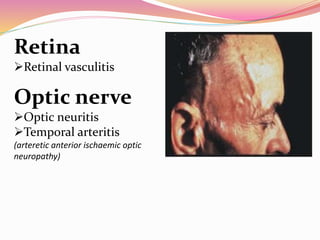 Retina
Retinal vasculitis
Optic nerve
Optic neuritis
Temporal arteritis
(arteretic anterior ischaemic optic
neuropathy)
 