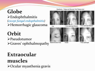 Globe
Endophthalmitis
(except fungal endopthalmitis)
Hemorrhagic glaucoma
Orbit
Pseudotumor
Graves’ ophthalmopathy
Extraocular
muscles
Ocular myasthenia gravis
 