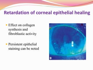 Retardation of corneal epithelial healing
 Effect on collagen
synthesis and
fibroblastic activity
 Persistent epithelial
staining can be noted
 