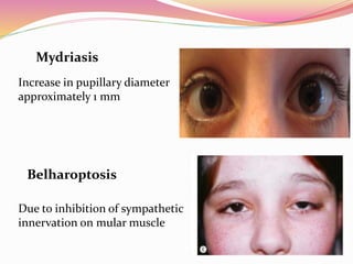 Mydriasis
Increase in pupillary diameter
approximately 1 mm
Belharoptosis
Due to inhibition of sympathetic
innervation on mular muscle
 