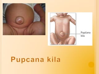 Infekcije pupka | PPTX