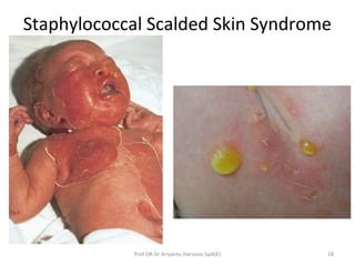 Staphylococcal Scalded Skin Syndrome
18Prof DR Dr Ariyanto Harsono SpA(K)
 