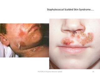 Staphylococcal Scalded Skin Syndrome…..
19Prof DR Dr Ariyanto Harsono SpA(K)
 