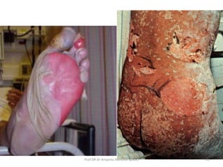 TEN…..
21Prof DR Dr Ariyanto Harsono SpA(K)
 