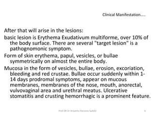 Clinical Manifestation…..
After that will arise in the lesions:
basic lesion is Erythema Exudativum multiforme, over 10% of
the body surface. There are several "target lesion" is a
pathognomonic symptom.
Form of skin erythema, papul, vesicles, or bullae
symmetrically on almost the entire body.
Mucosa in the form of vesicles, bullae, erosion, excoriation,
bleeding and red crustae. Bullae occur suddenly within 1-
14 days prodromal symptoms, appear on mucous
membranes, membranes of the nose, mouth, anorectal,
vulvovaginal area and urethral meatus. Ulcerative
stomatitis and crusting hemorrhagic is a prominent feature.
6Prof DR Dr Ariyanto Harsono SpA(K)
 