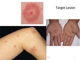 Target Lesion
Prof DR Dr Ariyanto Harsono SpA(K) 7
 