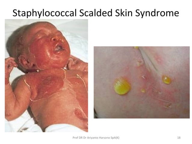Steven johnson syndrome & ten | PPT