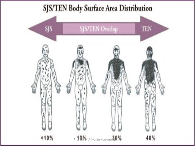 Steven johnson syndrome & ten
