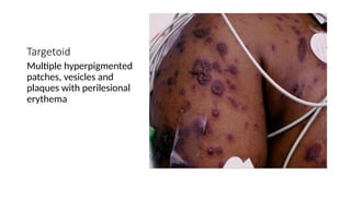 STEVEN JOHNSONS SYNDROME AND TOXIC EPIDERMAL NECROLYSIS [Autosaved] 2.pptx