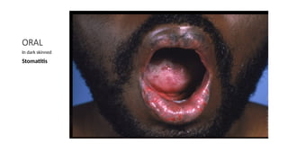 STEVEN JOHNSONS SYNDROME AND TOXIC EPIDERMAL NECROLYSIS [Autosaved] 2.pptx