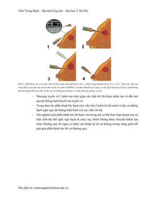 Trần Trung Bách – Bộ môn Ung thư – Đại học Y Hà Nội
Thư điện tử: trantrungbach@hmu.edu.vn
Hình 1. Minh hoạ các vị trí tiêm chất chỉ thị trong sinh thiết hạch cửa: 1. Tiêm trong da/dưới da vị trí u, 2 và 3. Tiêm trực tiếp vào
trong khối u và tiêm sâu vào tổ chức tuyến vú cạnh u KHÔNG còn được khuyến cáo (nguy cơ tắc bạch mạch do tế bào u ảnh hưởng
nên khả năng dấn lưu chất chỉ thị vào hệ thống bạch huyết), 4. Tiêm dưới da quầng vú) [3].
-­‐   Massage tuyến vú 5 phút sau tiêm giúp các chất chỉ thị được phân tán và dẫn lưu
qua hệ thống bạch huyết của tuyến vú.
-­‐   Trong thao tác phẫu thuật lấy hạch cửa, cần chú ý kiểm tra hố nách và lấy cả những
hạch nghi ngờ dù không hiện hình với các chất chỉ thị.
-­‐   Xét nghiệm giải phẫu bệnh tức thì hạch cửa trong mổ có thể thực hiện (hạch cửa có
tính chất đại thể nghi ngờ hạch di căn), tuy nhiên không được khuyến khích lựa
chọn thường quy do nguy cơ phải can thiệp lại do sự không tương xứng giữa kết
quả giải phẫu bệnh tức thì và thường quy.
 