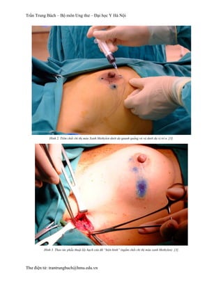 Trần Trung Bách – Bộ môn Ung thư – Đại học Y Hà Nội
Thư điện tử: trantrungbach@hmu.edu.vn
Hình 2. Tiêm chất chỉ thị màu Xanh Methylen dưới da quanh quầng vú và dưới da vị trí u [3].
Hình 3. Thao tác phẫu thuật lấy hạch cửa đã “hiện hình” (ngấm chất chỉ thị màu xanh Methylen) [3].
 