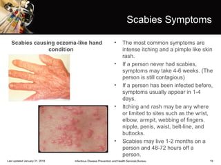 19
Scabies Symptoms
Scabies causing eczema-like hand
condition
• The most common symptoms are
intense itching and a pimple like skin
rash.
• If a person never had scabies,
symptoms may take 4-6 weeks. (The
person is still contagious)
• If a person has been infected before,
symptoms usually appear in 1-4
days.
• Itching and rash may be any where
or limited to sites such as the wrist,
elbow, armpit, webbing of fingers,
nipple, penis, waist, belt-line, and
buttocks.
• Scabies may live 1-2 months on a
person and 48-72 hours off a
person.
Infectious Disease Prevention and Health Services BureauLast updated January 31, 2018
 