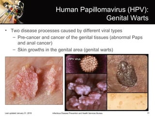 31
Human Papillomavirus (HPV):
Genital Warts
• Two disease processes caused by different viral types
– Pre-cancer and cancer of the genital tissues (abnormal Paps
and anal cancer)
– Skin growths in the genital area (genital warts)
Infectious Disease Prevention and Health Services BureauLast updated January 31, 2018
 