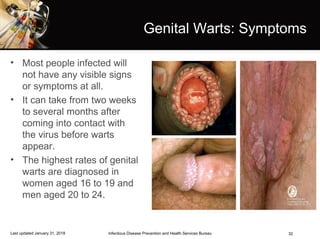 32
Genital Warts: Symptoms
• Most people infected will
not have any visible signs
or symptoms at all.
• It can take from two weeks
to several months after
coming into contact with
the virus before warts
appear.
• The highest rates of genital
warts are diagnosed in
women aged 16 to 19 and
men aged 20 to 24.
Infectious Disease Prevention and Health Services BureauLast updated January 31, 2018
 