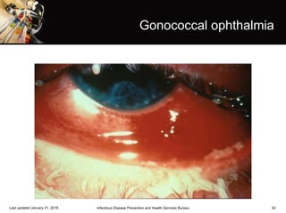 42
Gonococcal ophthalmia
Infectious Disease Prevention and Health Services BureauLast updated January 31, 2018
 