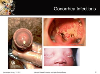 43
Gonorrhea Infections
Infectious Disease Prevention and Health Services BureauLast updated January 31, 2018
 