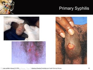 55
Primary Syphilis
Photos: Dr. Joseph Engelman, San Francisco City ClinicInfectious Disease Prevention and Health Services BureauLast updated January 31, 2018
 