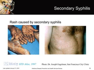 59
Secondary Syphilis
Photo: Dr. Joseph Engelman, San Francisco City ClinicSTD Atlas, 1997
Infectious Disease Prevention and Health Services BureauLast updated January 31, 2018
Rash caused by secondary syphilis
 