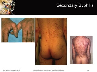 60
Secondary Syphilis
Infectious Disease Prevention and Health Services BureauLast updated January 31, 2018
 