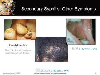 61
Secondary Syphilis: Other Symptoms
Photo: Dr. Joseph Engelman
San Francisco City Clinic
Comdyloma lata
DOIA Website, 2000
STD Atlas, 1997
Infectious Disease Prevention and Health Services BureauLast updated January 31, 2018
 